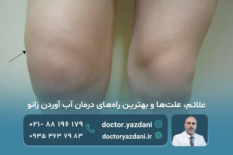 عکس زانو آب آورده