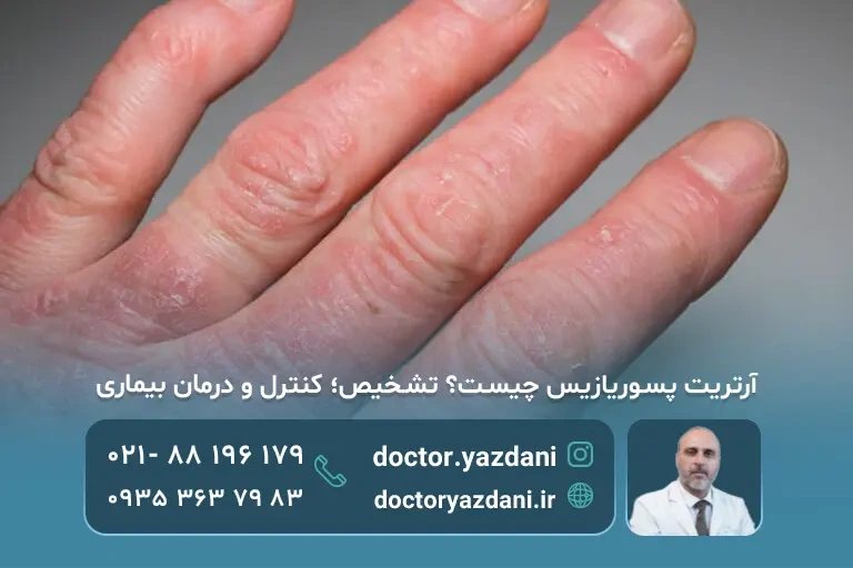 درمان آرتریت پسوریازیک