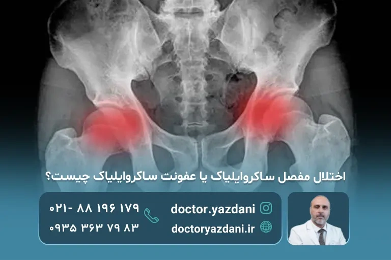 اختلال مفصل ساکروایلیاک