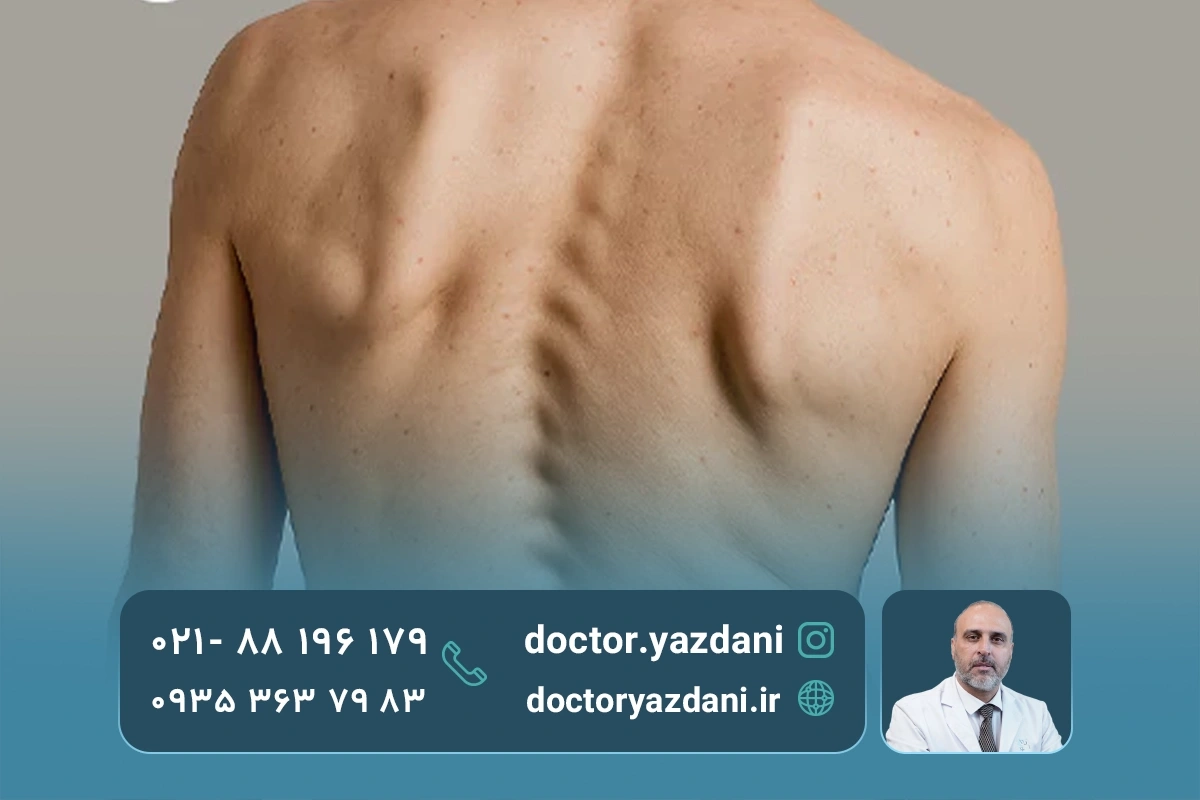 اسکولیوز یا انحراف ستون‌ فقرات چیست؟
