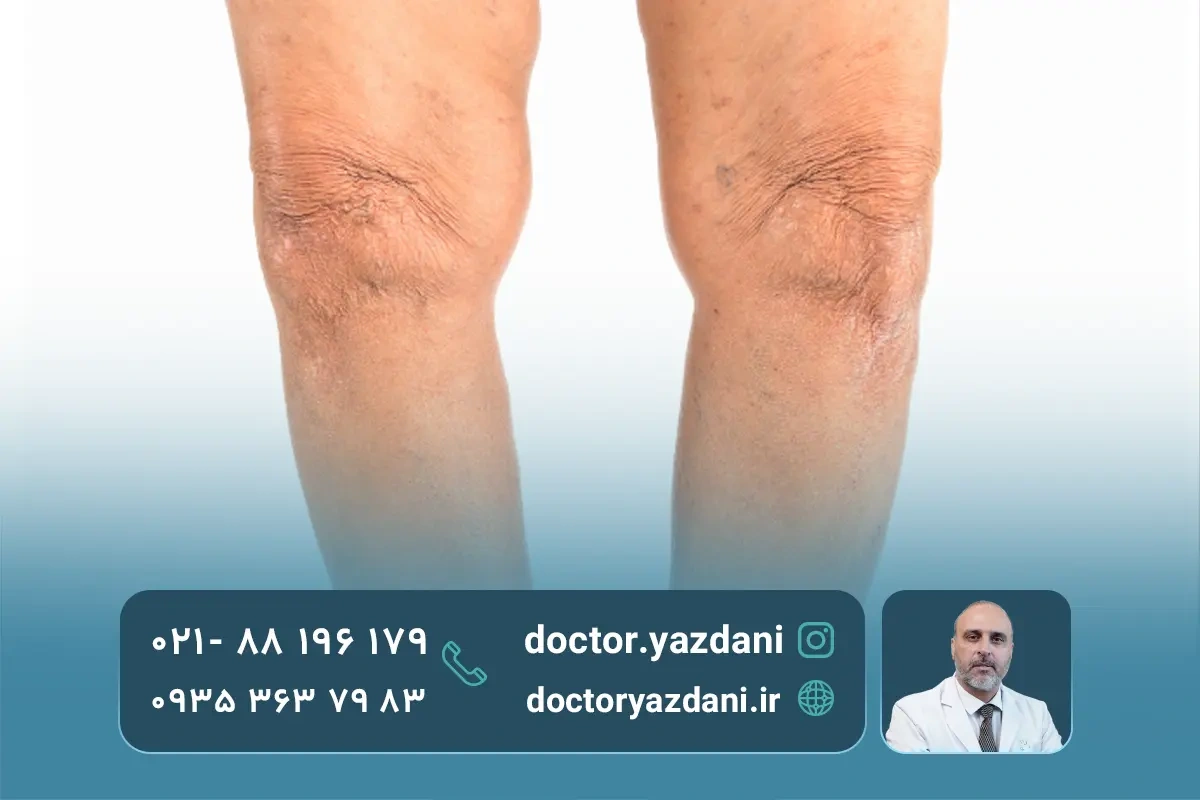 انحراف زانو چیست؟