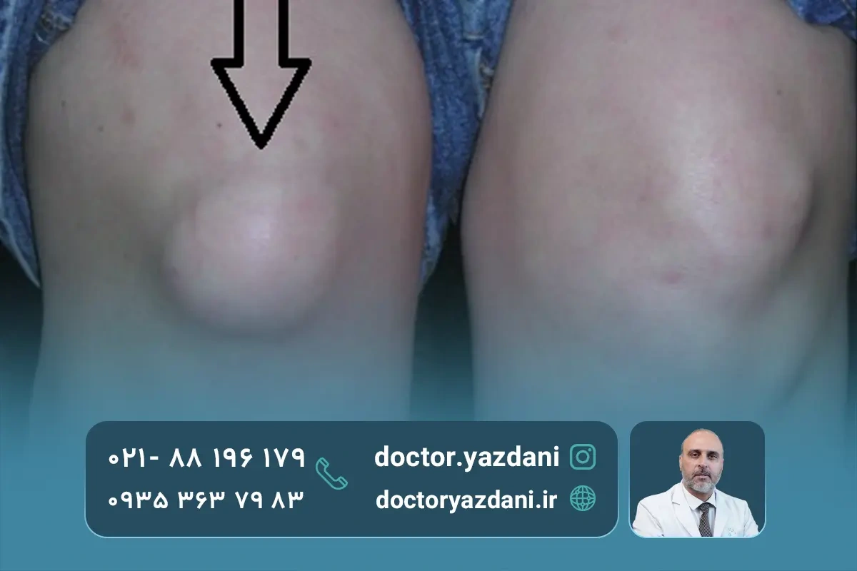 انواع بورسیت زانو