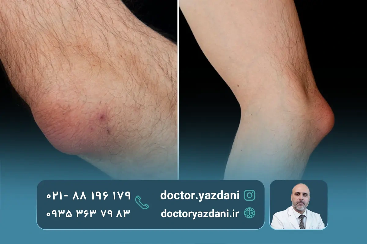 انواع بورسیت شانه