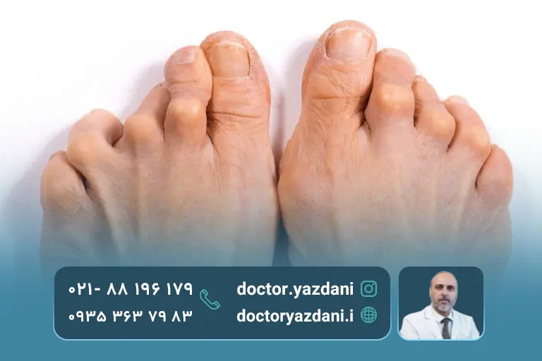 آرتروز-پیشرفته-و-خطرناک