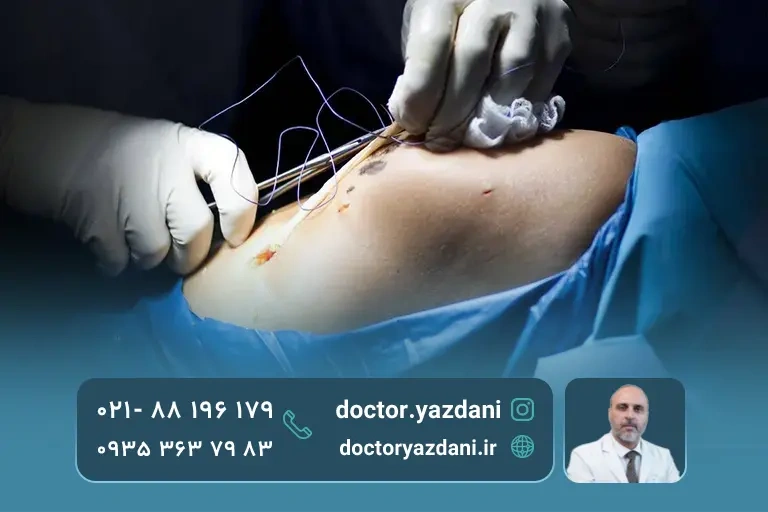 باید ها و نباید های عمل پارگی مینیسک