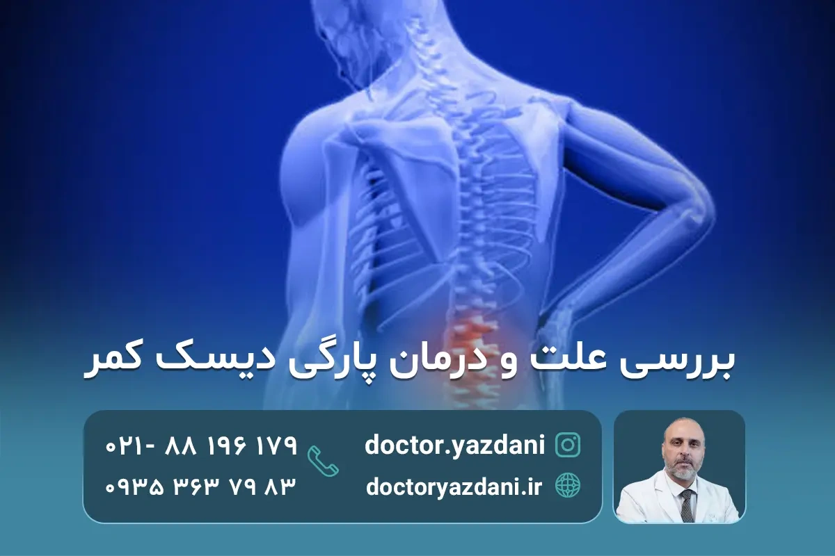 پارگی دیسک کمر؛ علائم، علت‌ها و بهترین روش‌های درمان