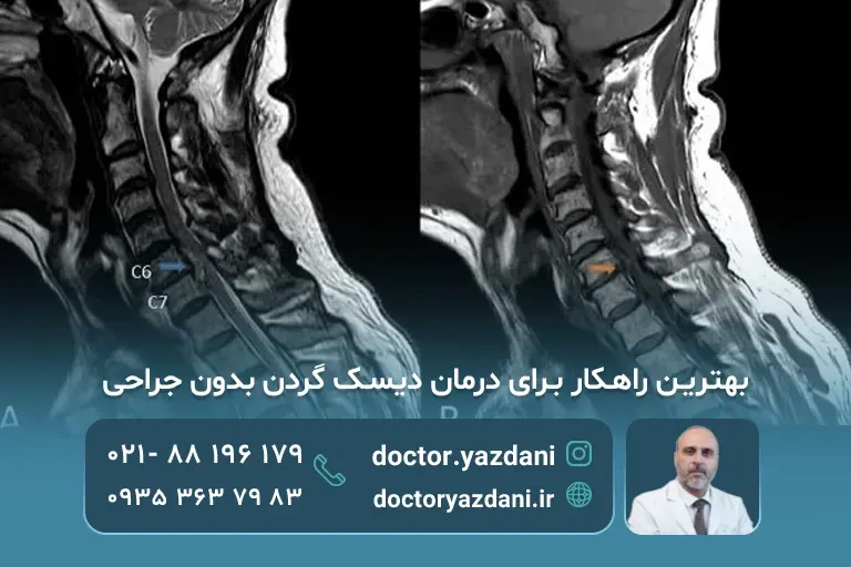 روش بدون جراحی برای درمان دیسک گردن