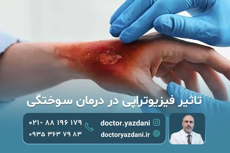 عکس یه عضو بدن سوخته که داره به دست پزشک فیزیوتراپی میشه