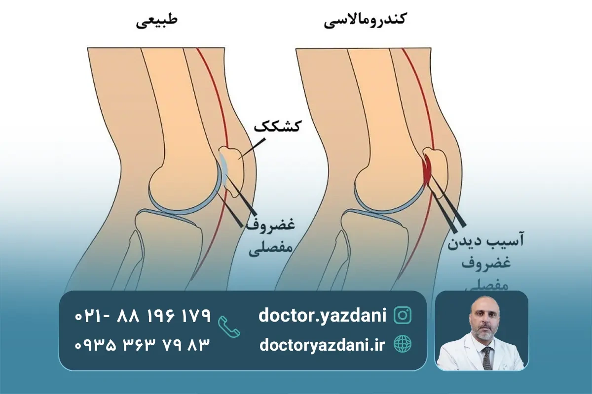 تاندونیت زانو چیست؟