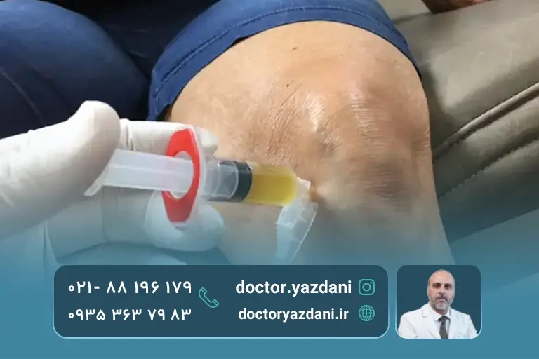 تزریق prp به ناحیه آسیب دیده زانوی بیمار