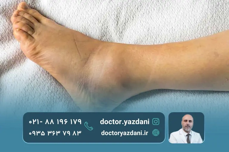 عکس مفصل پا با نشانه التهاب و تورم