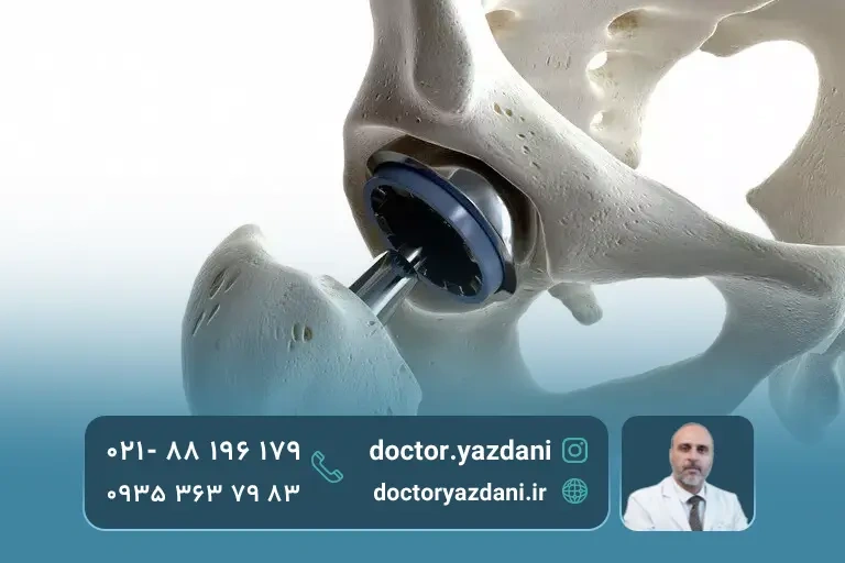 تعویض مفصل لگن