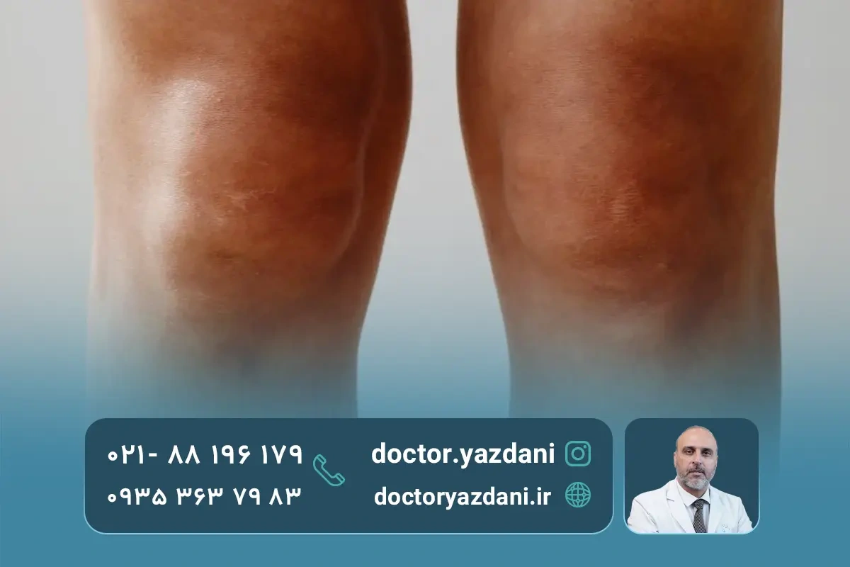 تفاوتِ زانویِ ضربدری در کودکان و بزرگسالان