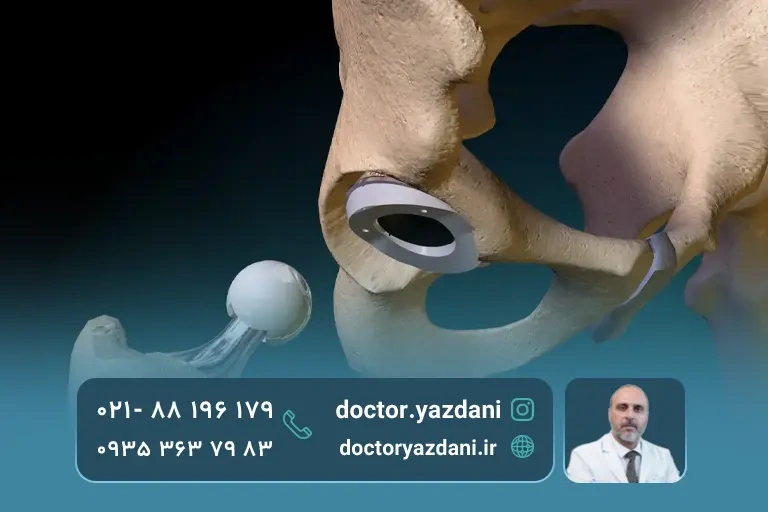 تعویض مفصل چگونه انجام میشود؟