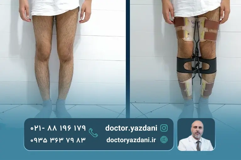 درمان مشکل پای پرانتزی در بزرگسالان