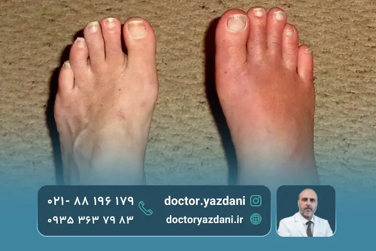 درمان روماتیسم پا