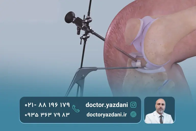 عکس عمل مینیسک زانو