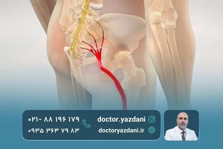 فیزیوتراپی رگ سیاتیک