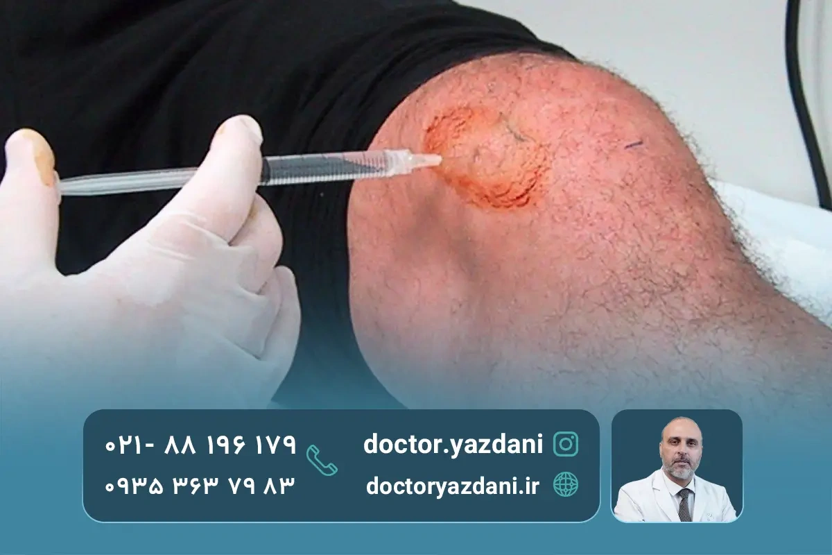 عفونت بیشتر در کدام مفاصل ایجاد می‌شود؟