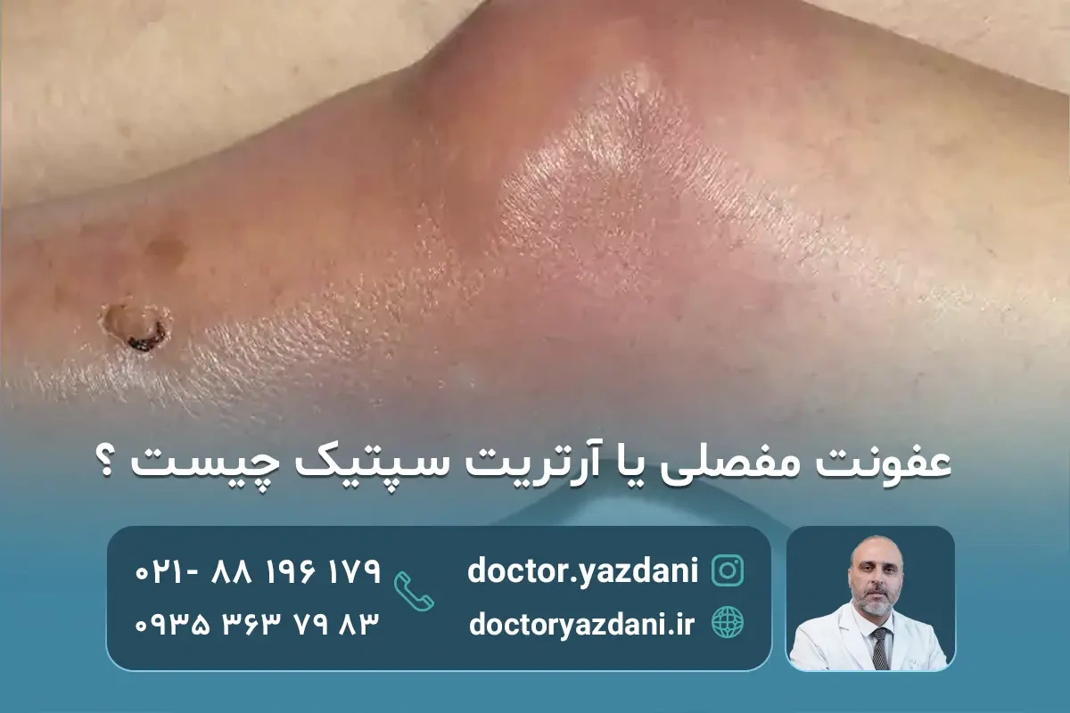 عفونت مفصل چیست؟ علائم، علت ها و روش های درمان