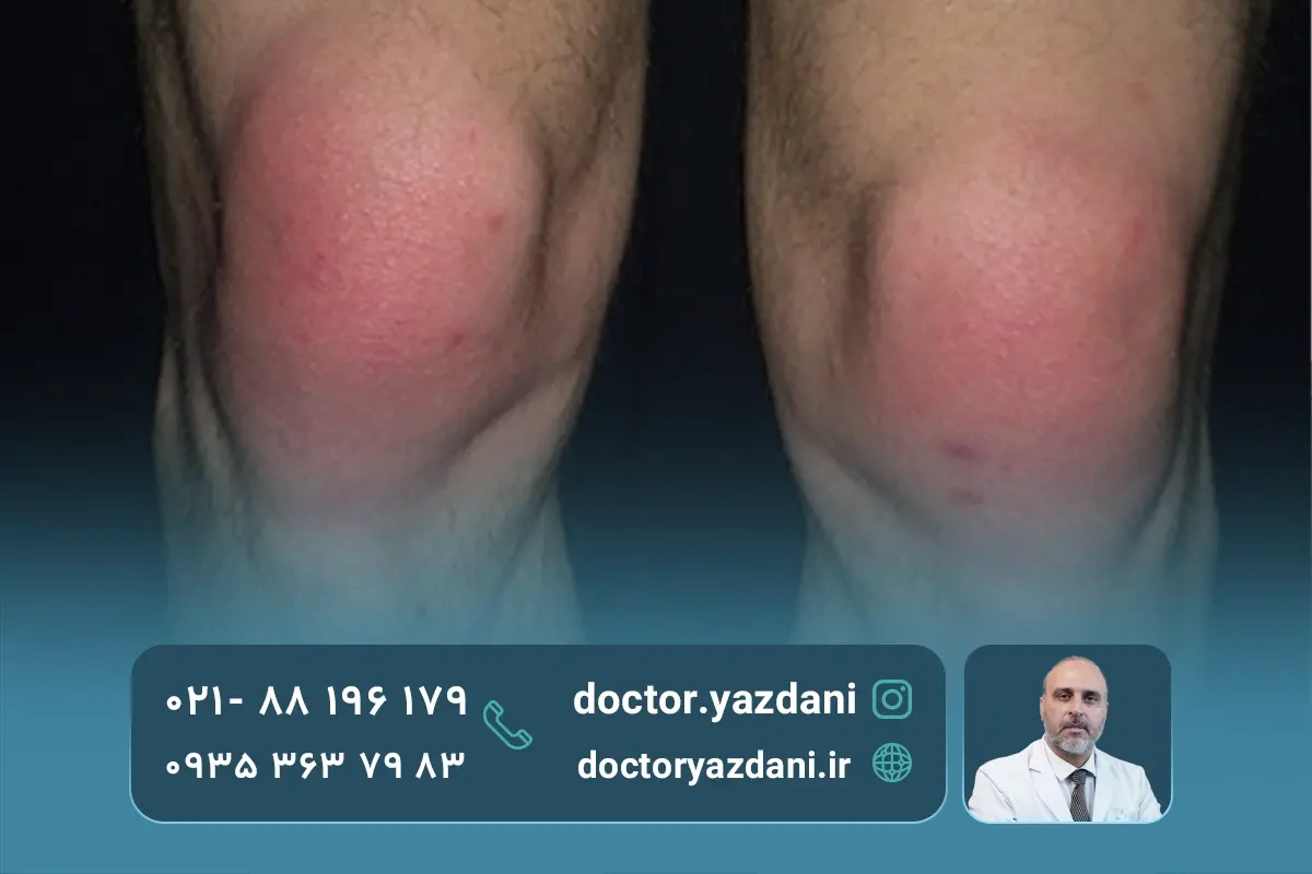 علائم بورسیت زانو