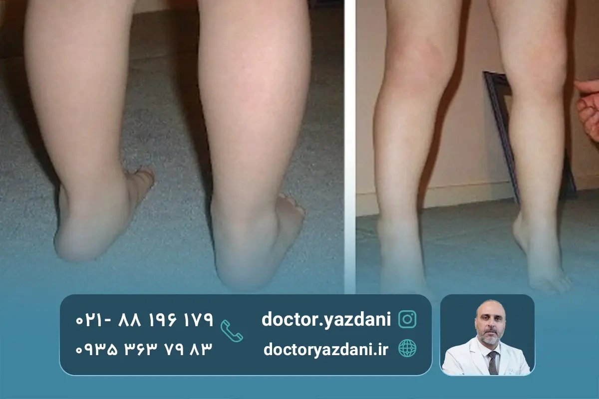 علائم زانوی ضربدری در کودکان