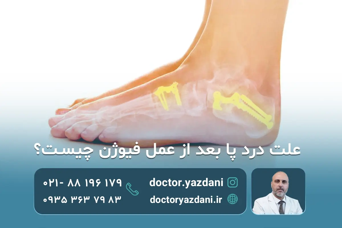 علت درد پا بعد از عمل فیوژن؟روش های درمان آن