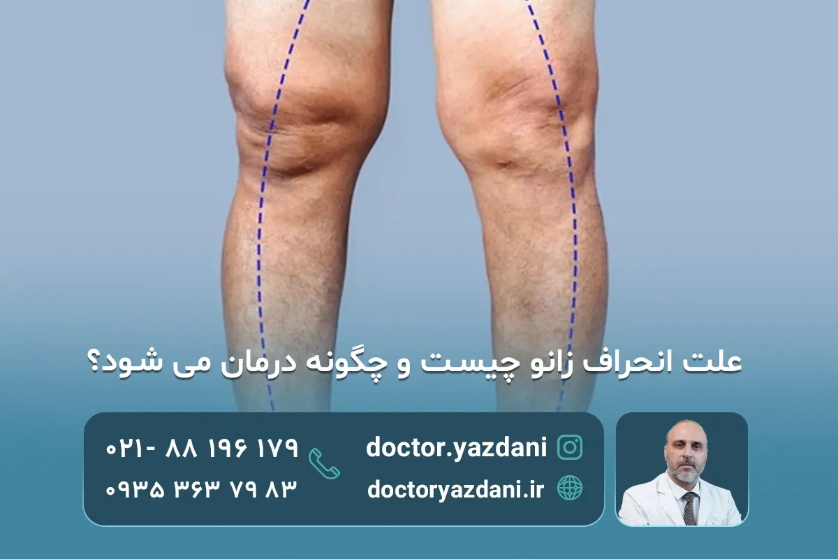 علت انحراف زانو چیست؟بهترین راه های درمان آن