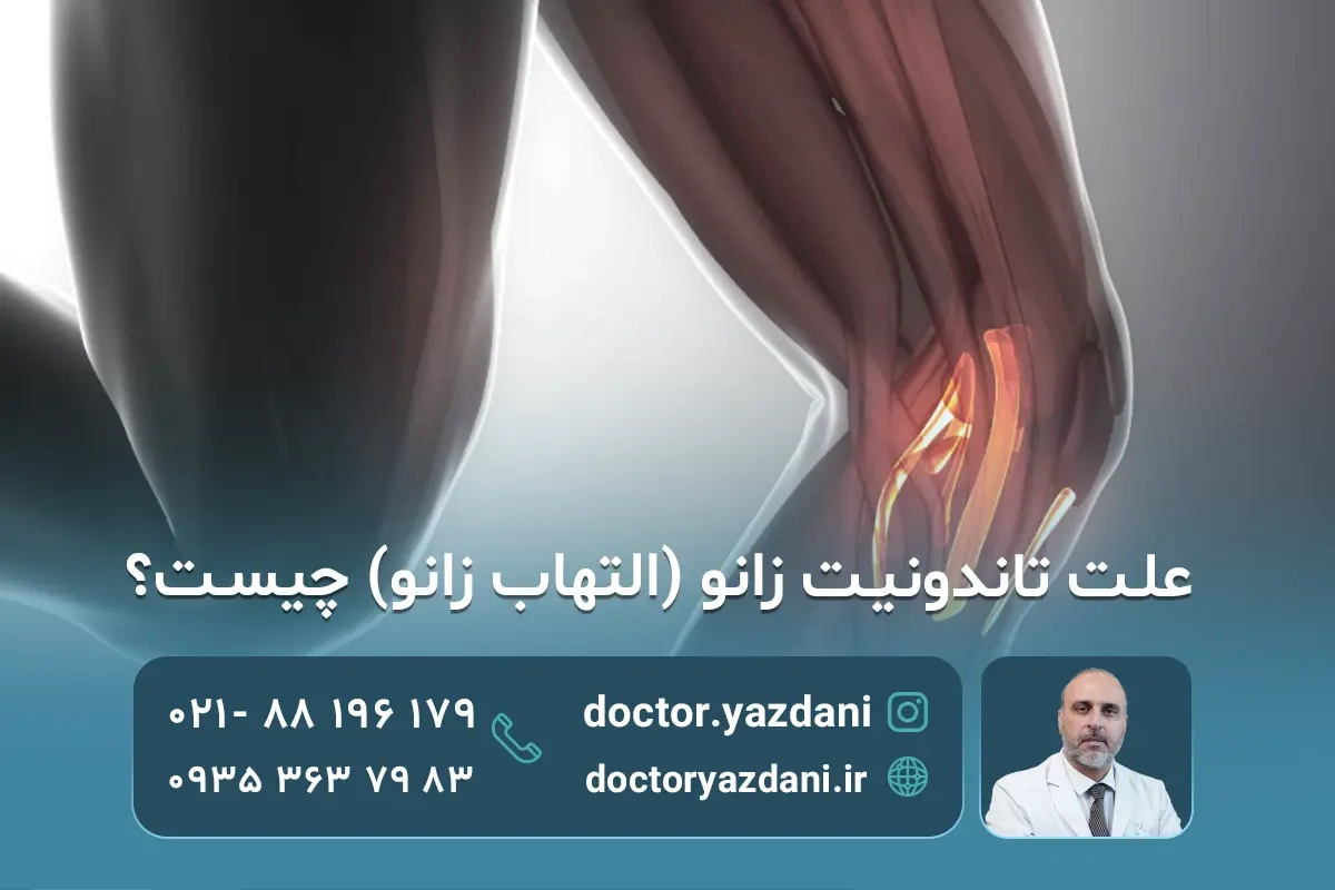تاندونیت زانو چیست؟ علائم، علت‌ها و بهترین روش‌های درمان