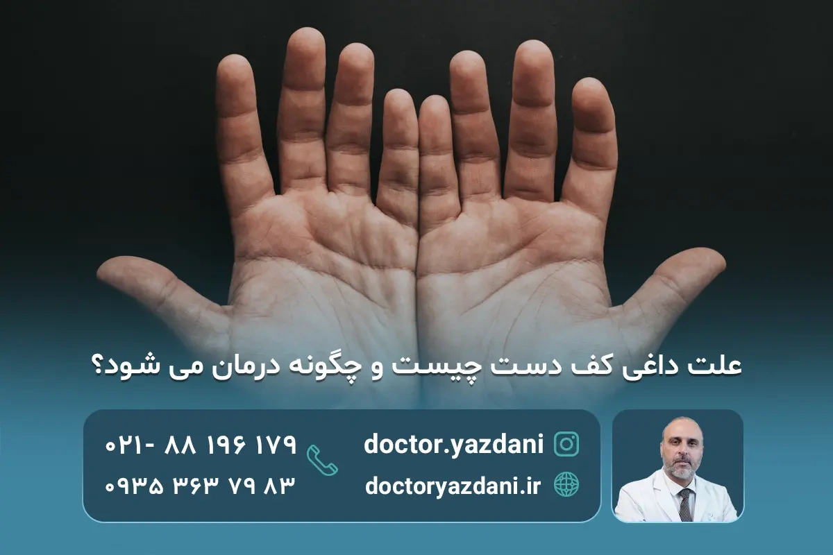 داغی کف دست نشانه چیست؟ بهترین روش های درمان
