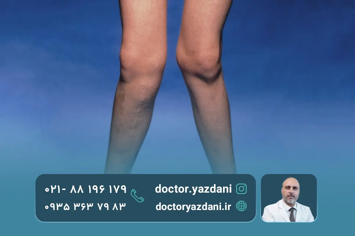 علت زانو ضربدری در کودکان