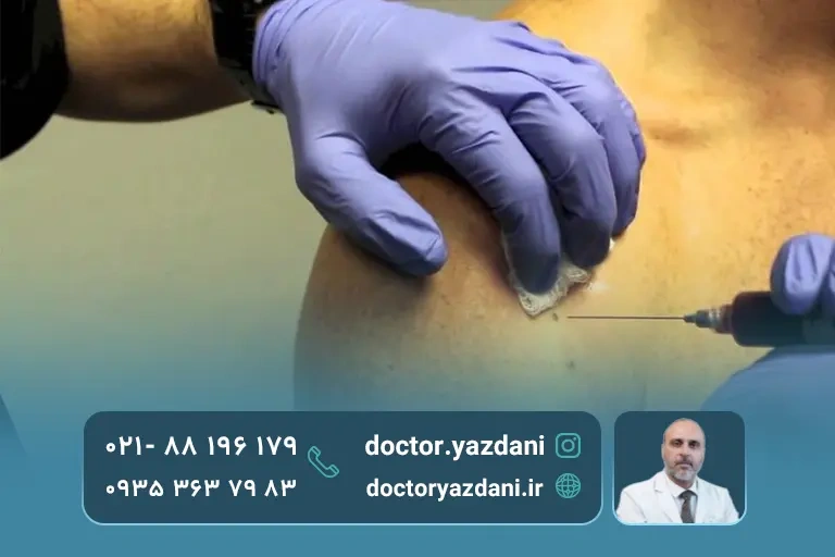 عوارض تزریق prp به شانه
