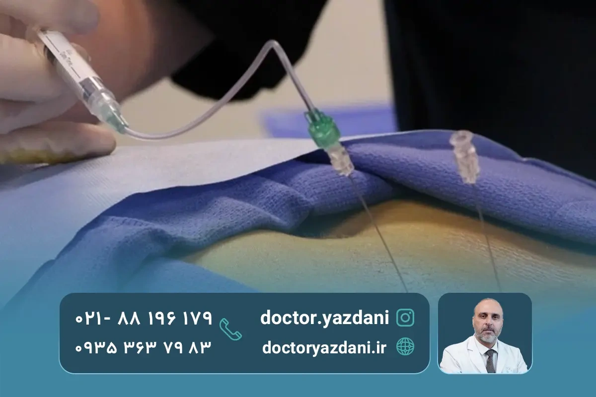 عوارض تزریق اپیدورال