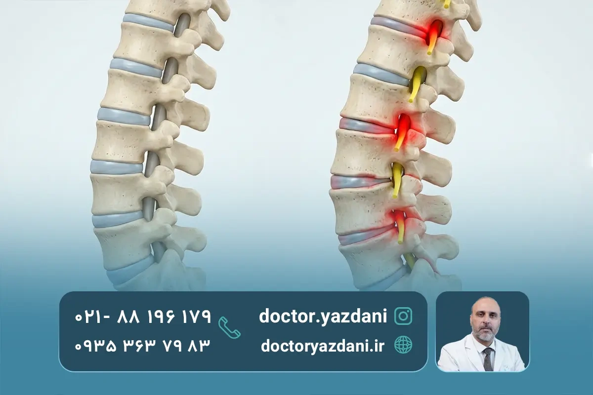 عوارض رایج گودی کمر