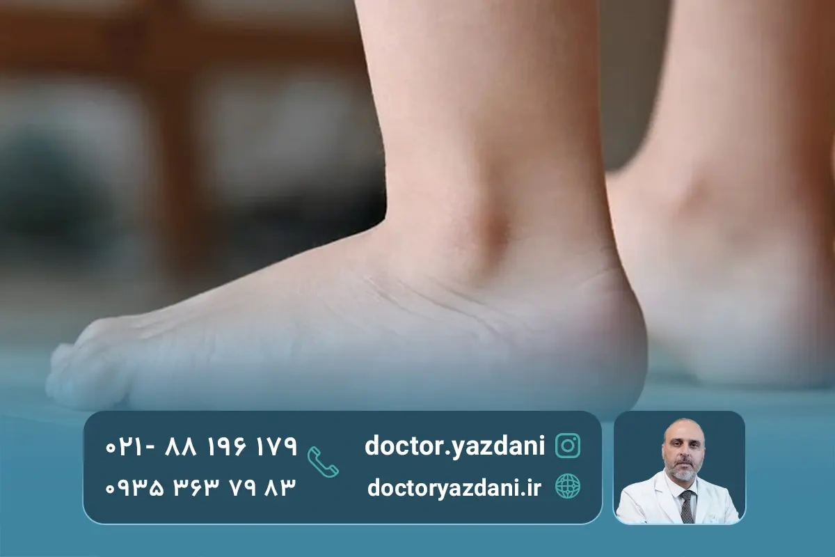 عوارض صافی کف پا در کودکان