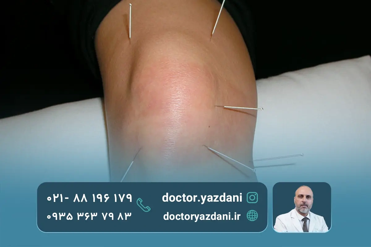 عوارض طب سوزنی در درمان زانو