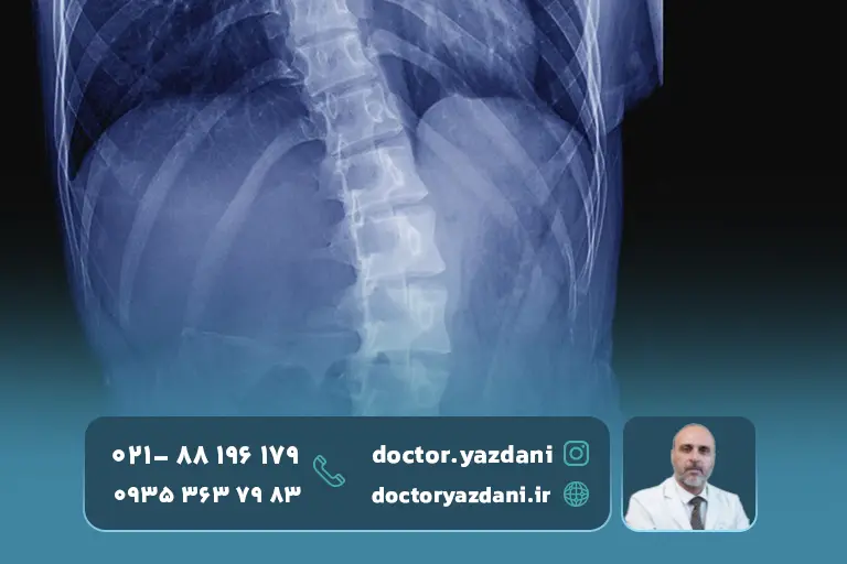 عکس-اسکولیوز