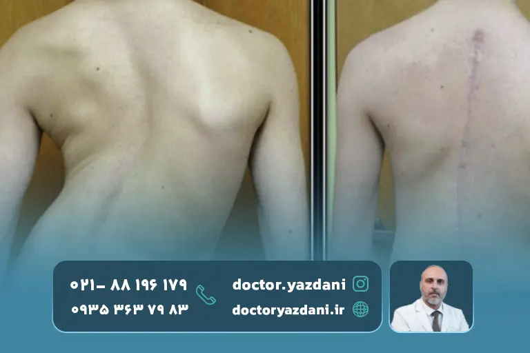 عکس-ستون-فقرات-منحرف-شده