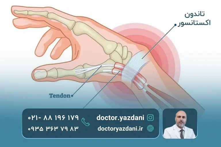 عکس آناتومی انگشت ماشه ای