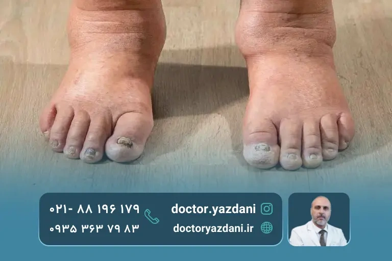 مشکل مفصل نوروپاتیک شارکو