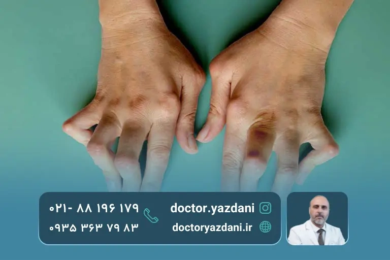 انگشتان کج شده به علت آرتریت