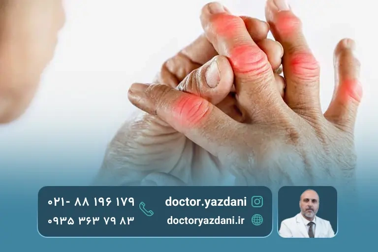 آرتریت روماتوئید انگشتان دست