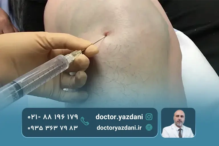 عکس تزریق و درمان زانوی آب آورده