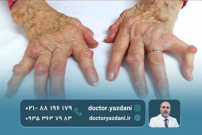 عکس روماتیسم مفصل انگشتان خانم مسن