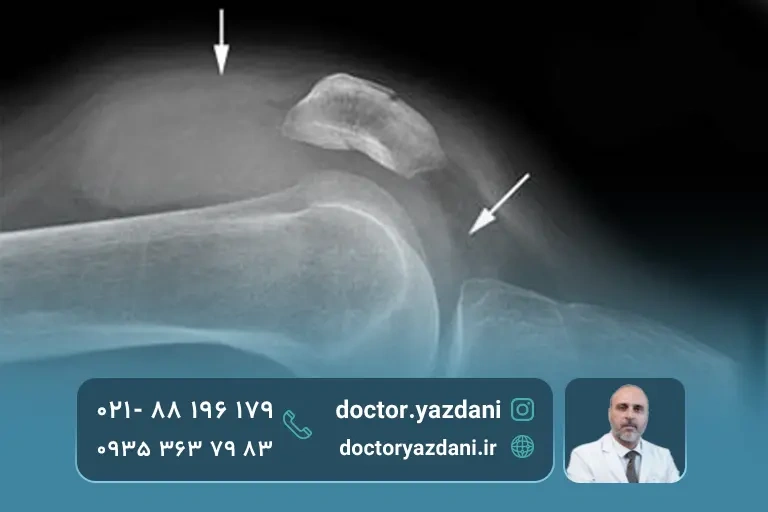 عکس زانوی آب آورده