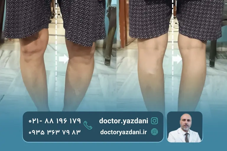 عکس زانوی پرانتزی در بزرگسالان