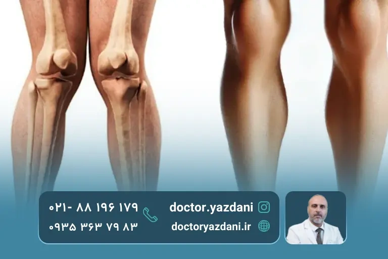 عکس زانوی عادی و زانوی ضربدری مقایسه ای