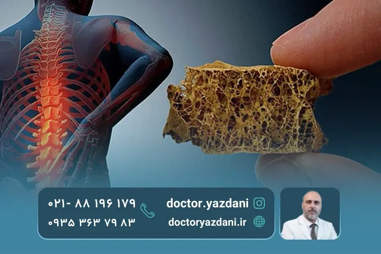 پیشگیری از پوکی استخوان