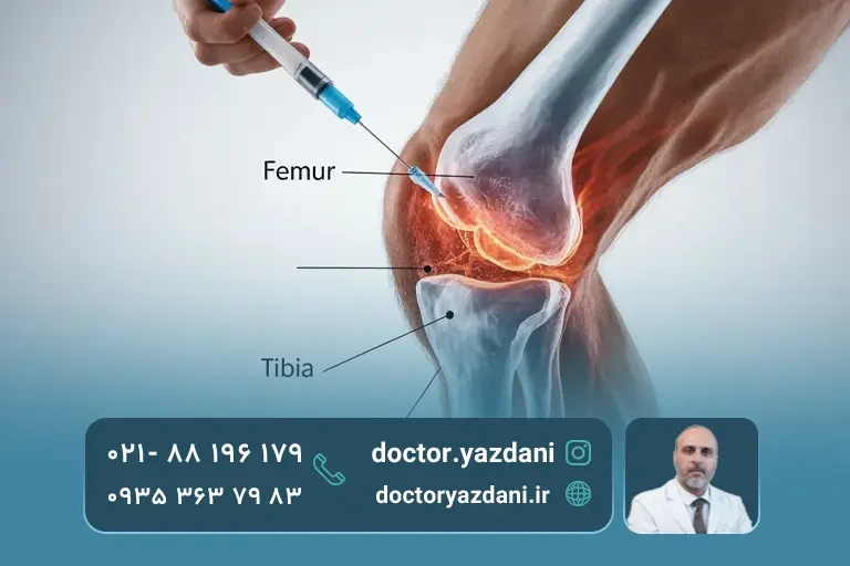 عکس عارضه بعد از تزریق پی آر پی به زانو
