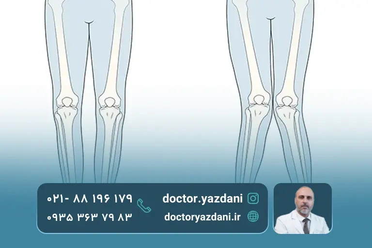 عکس پای ضربدری